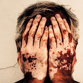 Ayurvedic Treatment for Leucoderma (Safed Daag)