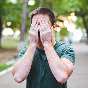 10 myths about Leucoderma